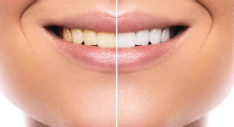teeth-comparison